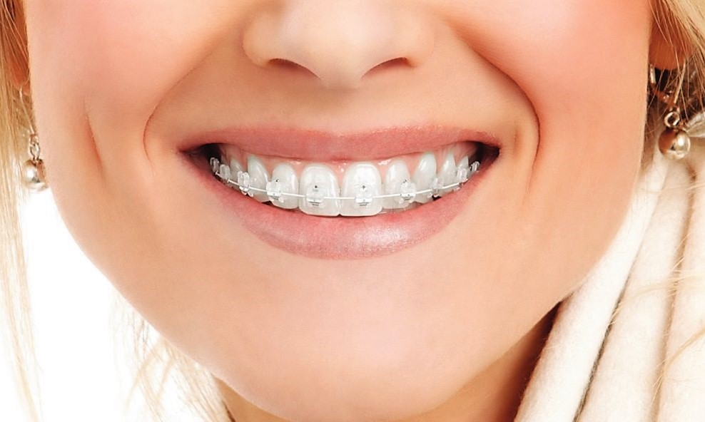 скільки коштує поставити брекети в Україні