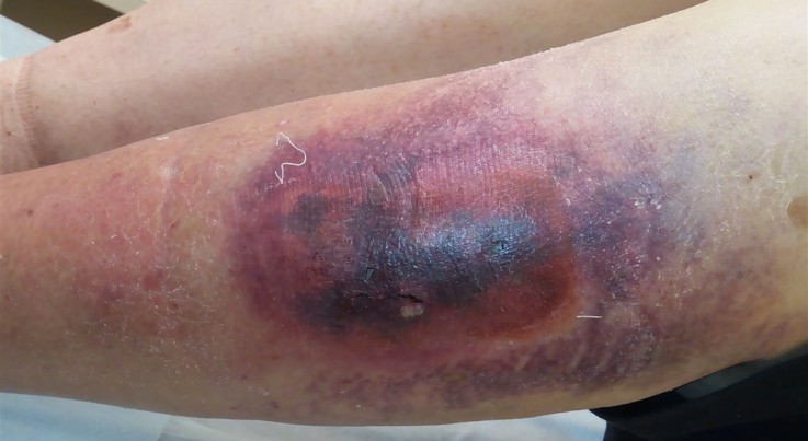 внутрішня кровотеча симптоми