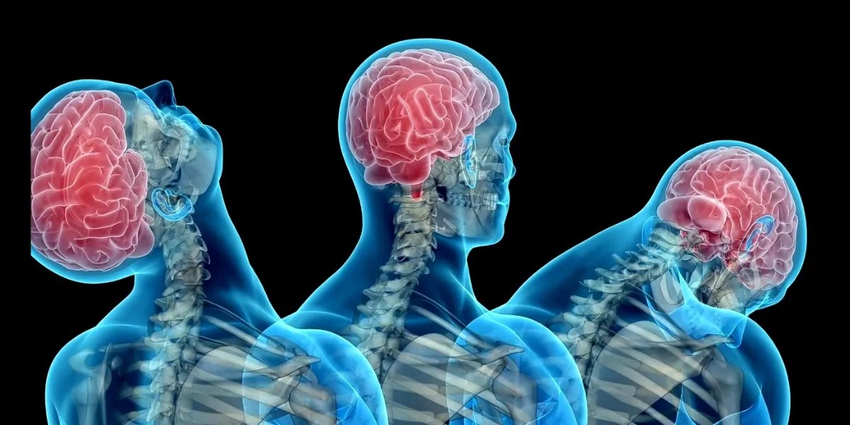 як лікувати струс мозку вдома