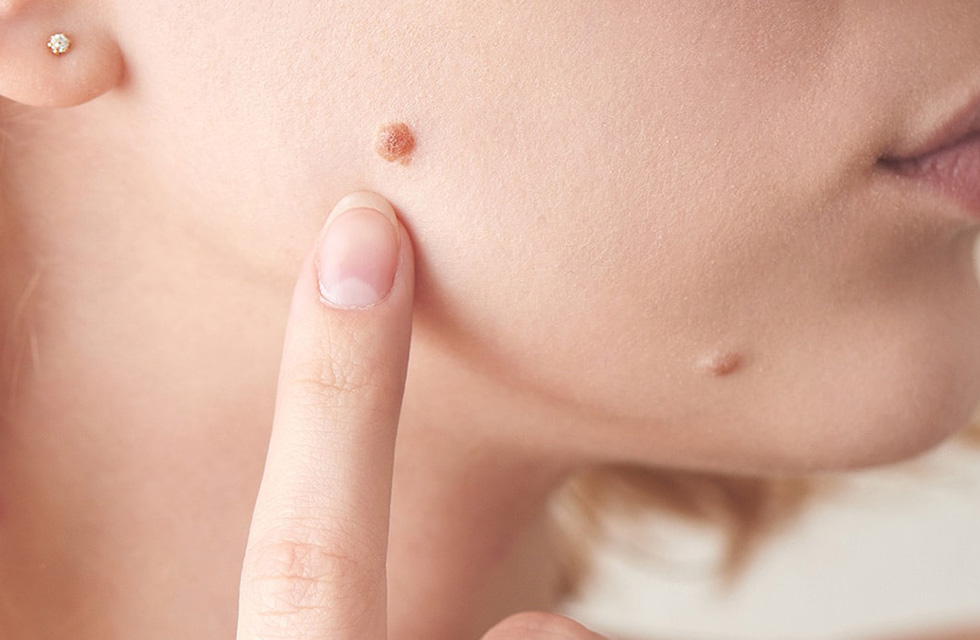 Як позбутися папілом